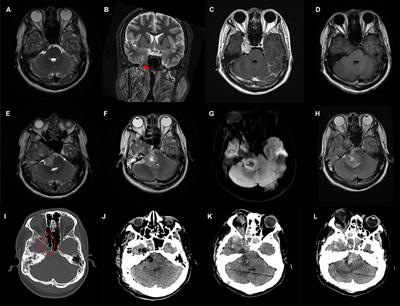 Atypical Teratoid/Rhabdoid Tumor Originated From the Trigeminal Nerve in a Young Male Adult: Case Report and Review of the Literature
